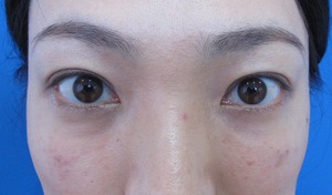 目の下のたるみ、目のくまでお悩みの方、切らずに完璧に解決します。TCB-R法　手術直後　症例写真